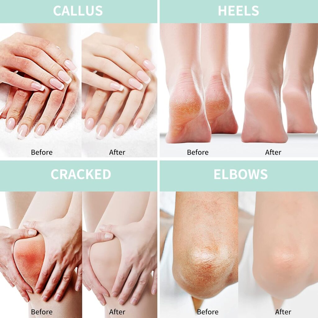 Urea Cream 40 Percent