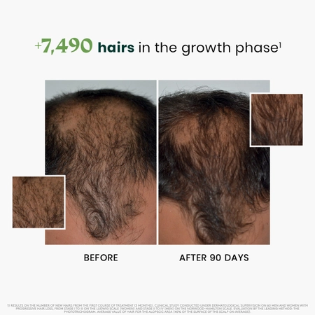 pie_rf_sept24-progressive-thinning-hair-kit_alt-img_2_1200 Triphasic Progressive Thinning Hair Routine